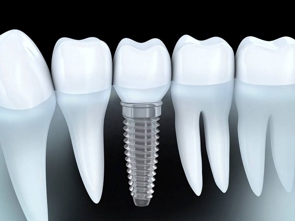 cấy răng implant, cấy răng implant bao nhiêu tiền, cấy răng implant mất thời gian bao lâu, cấy răng implant giá bao nhiêu, cấy răng implant như thế nào, cấy răng implant ở hà nội, cấy răng implant giá, cấy răng implant mất bao lâu, cấy ghép răng implant giá bao nhiêu, cấy ghép răng implant, giá cấy răng implant, quy trình cấy răng implant, giá cấy răng implant ở hà nội, cấy răng implant, các bước cấy răng implant, trước và sau khi cấy răng implant, cấy răng implant bao nhiêu tiền, cấy răng implant mất thời gian bao lâu, cấy răng implant giá bao nhiêu, cấy răng implant như thế nào