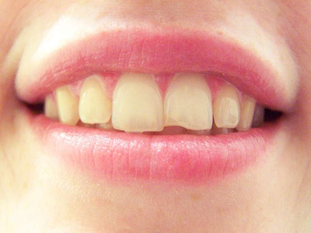 răng nhiễm kháng sinh, tẩy trắng răng nhiễm kháng sinh, răng nhiễm kháng sinh là gì, răng bị nhiễm fluor, răng bị nhiễm kháng sinh tetracycline, răng nhiễm màu tetracyclin,răng bị nhiễm kháng sinh, răng nhiễm fluor có tẩy trắng được không, răng nhiễm màu kháng sinh, răng bị nhiễm màu kháng sinh, cách chữa răng bị nhiễm fluor, răng nhiễm fluor, tẩy trắng răng nhiễm tetracycline, răng nhiễm tetra có tẩy trắng được không, răng vàng bẩm sinh, răng ố vàng bẩm sinh, răng bị nhiễm tetra, tẩy trắng răng bị nhiễm fluor, cách chữa răng nhiễm tetracycline hiệu quả nhất, răng bị nhiễm tetracycline la gi, răng nhiễm kháng sinh có tẩy được không