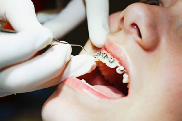 các bước niềng răng khấp khểnh, quá trình niềng răng như thế nào, các giai đoạn niềng răng hô, quy trình niềng răng khấp khểnh, quá trình niềng răng khấp khểnh, quy trình niềng răng như thế nào, quy trình niềng răng móm, quy trình niềng răng khểnh, các quy trình niềng răng, quy trình niềng răng thưa, quy trình niềng răng hô, quy trình niềng răng mắc cài, quy trình niềng răng mắc cài sứ, quy trình niềng răng