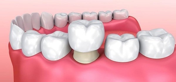 răng chụp sứ bị nhức, bọc răng sứ bị nhức,bọc răng sứ khó chịu,bọc răng sứ bị đau nhức,bọc răng sứ bị đau,bọc răng sứ không khít,răng sứ bị đau,răng bọc sứ bị nhức,răng bọc sứ bị đau,sau khi bọc răng sứ bị đau nhức,cảm giác sau khi bọc răng sứ, trồng răng sứ bị nhức, đau răng sau khi bọc sứ, đau nhức sau khi bọc răng sứ, bọc răng sứ nhai bị đau, bọc răng sứ và những biến chứng khó lường