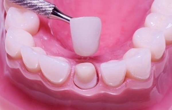 Tác hại của bọc răng sứ,bọc răng sứ lợi và hại