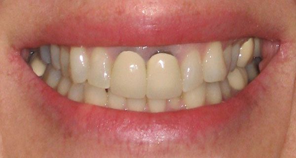 bọc răng sứ bị tụt lợi,răng bọc bị tụt lợi,hậu quả của việc bọc răng sứ,hậu quả của việc làm răng sứ, làm răng sứ bị tụt lợi