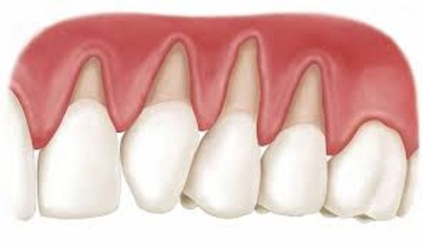 làm răng sứ bị tụt lợi, bọc răng sứ bị tụt lợi,răng bọc bị tụt lợi,hậu quả của việc bọc răng sứ,hậu quả của việc làm răng sứ