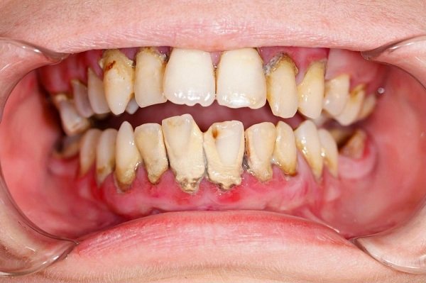 bọc răng sứ có bị hôi miệng không, bọc răng sứ bị hôi miệng, tại sao bọc răng sứ bị hôi miệng, tại sao bọc răng sứ lại bị hôi miệng, bị hôi miệng sau khi bọc răng sứ, bọc răng sứ hôi miệng, bọc răng sứ gây hôi miệng, bọc răng sứ có hôi miệng không, bọc răng sứ có gây hôi miệng không, răng sứ bị hôi, làm răng sứ có bị hôi miệng không, lý do bị hôi miệng, lý do hôi miệng, làm cầu răng bọc răng sứ có bị hôi miệng, răng sứ bị hôi phải làm sao, tại sao bọc răng sứ bị hôi, bọc răng sứ bị hôi, bọc răng sứ có bị hôi miệng
