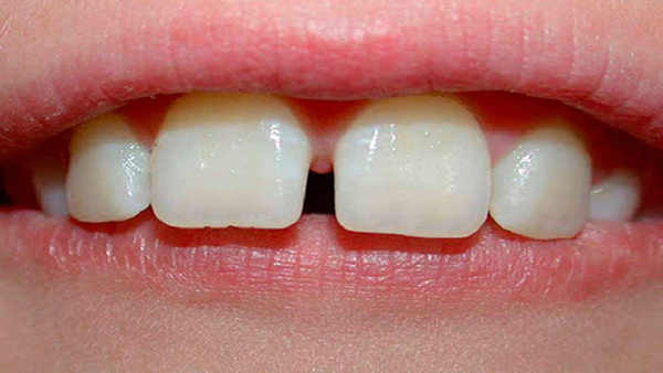răng thưa,cải thiện răng thưa,niềng răng thưa mất bao lâu,răng cửa thưa trong tướng số,răng cửa thưa tướng số,răng thưa nói láo,răng thưa sướng hay khổ,răng thưa thừa của,xem tướng đàn ông răng thưa,trám răng thưa,niềng răng thưa,răng thưa phải làm sao,cách làm răng thưa khít lại tại nhà,cách làm răng hết thưa tại nhà,răng thưa có xấu không,răng thưa có ý nghĩa gì,răng nhỏ và thưa,răng thưa nói lên điều gì,niềng răng có ảnh hưởng đến tướng số,điều trị răng thưa,răng thưa tướng số,cách trị răng thưa tại nhà,răng thưa thì sao, răng thưa hàm trên, răng cửa thưa phong thủy