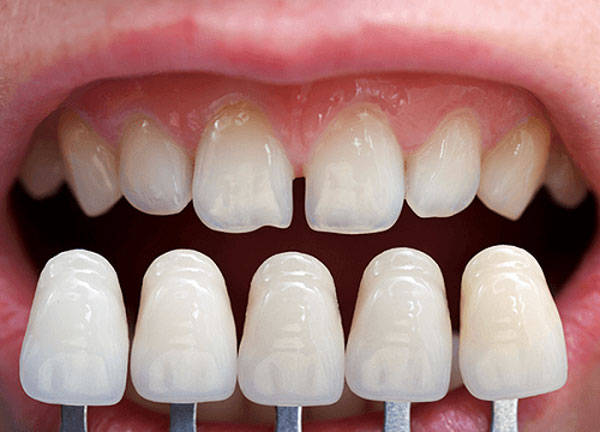răng thưa,cải thiện răng thưa,niềng răng thưa mất bao lâu,răng cửa thưa trong tướng số,răng cửa thưa tướng số,răng thưa nói láo,răng thưa sướng hay khổ,răng thưa thừa của,xem tướng đàn ông răng thưa,trám răng thưa,niềng răng thưa,răng thưa phải làm sao,cách làm răng thưa khít lại tại nhà,cách làm răng hết thưa tại nhà,răng thưa có xấu không,răng thưa có ý nghĩa gì,răng nhỏ và thưa,răng thưa nói lên điều gì,niềng răng có ảnh hưởng đến tướng số,điều trị răng thưa,răng cửa to nói lên điều gì,răng thưa tướng số,cách trị răng thưa tại nhà