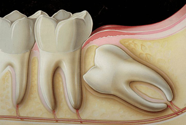 sưng nướu răng hàm,sưng nướu răng hàm trên, sưng lợi hàm trên, sưng lợi răng hàm trên, sưng nướu hàm trên, đau lợi hàm trên, viêm lợi hàm trên, sưng lợi hàm trên răng cửa, sưng nướu răng trong cùng hàm trên, viêm nướu răng hàm trên, sưng lợi trong cùng hàm trên, sưng lợi răng hàm, bị sưng nướu răng trong cùng hàm trên, bị sưng lợi hàm trên, sưng chân răng hàm trên, sưng nướu răng không đau, sưng hàm trên, đau nướu hàm trên