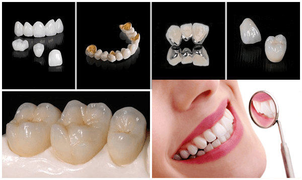 Bọc răng sứ mất bao lâu thời gian?