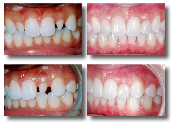 răng thưa bọc sứ duy trì được bao lâu, răng thưa bọc sứ sử dụng được bao lâu