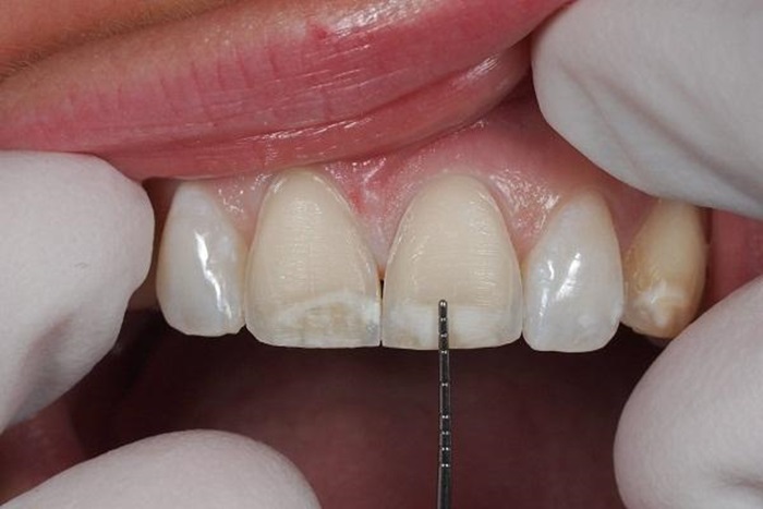 công nghệ phủ răng sứ invy ultra 3p, công nghệ phủ răng sứ invy ultra 3p giá bao nhiêu