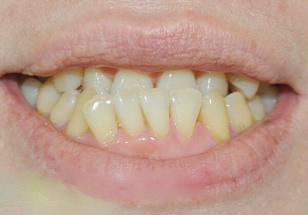 răng quặp, răng quặp ki bo,răng cửa quặp vào trong, chữa răng quặp, răng quặp có ý nghĩa gì, răng quặp là gì, xem tướng răng quặp, răng quặp là như thế nào, người răng quặp, niềng răng quặp, răng quặp vào trong, tướng răng quặp, đàn ông răng quặp, phụ nữ răng quặp, răng cụp vào trong, chữa răng quặp, răng quặp có niềng được không, răng quắp vào, răng cụp, niềng răng quặp, răng bị cụp vào trong, răng bị quặp vào trong