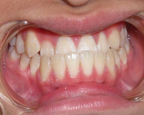 chỉnh hình răng quặp vào, răng quặp, răng quặp ki bo, răng cửa quặp vào trong, chữa răng quặp, răng quặp có ý nghĩa gì, răng quặp là gì, xem tướng răng quặp, răng quặp là như thế nào, người răng quặp, niềng răng quặp, răng quặp vào trong, tướng răng quặp, đàn ông răng quặp, phụ nữ răng quặp, răng cụp vào trong, chữa răng quặp, răng quặp có niềng được không, răng quắp vào, răng cụp, niềng răng quặp, răng bị cụp vào trong, răng bị quặp vào trong