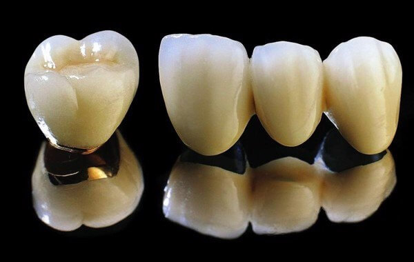 răng sứ kim loại, răng sứ kim loại thường, răng sứ kim loại là gì, răng sứ kim loại mỹ, răng sứ kim loại mỹ có tốt không, răng sứ kim loại có bền không, răng sứ kim loại giá bao nhiêu, răng sứ kim loại có tuổi thọ bao lâu,răng sứ kim loại tốt không,,có nên bọc răng sứ kim loại,có nên trồng răng sứ kim loại không, bọc răng sứ kim loại, bọc răng sứ kim loại được bao lâu, bọc răng sứ kim loại thường, bọc răng sứ kim loại có đau không, độ bền của răng sứ kim loại, quy trình bọc răng sứ kim loại, các loại răng sứ kim loại