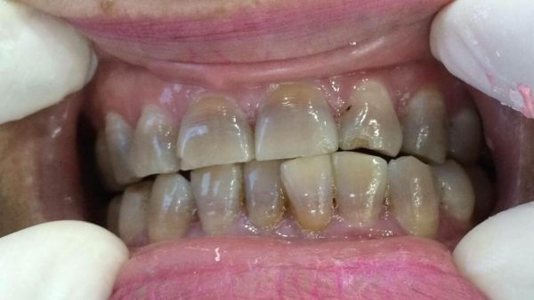 Răng bị nhiễm Tetracycline, Răng bị nhiễm kháng sinh