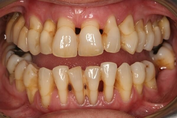 hở chân răng, viêm lợi hở chân răng, Nguyên nhân hở chân răng, Bị hở chân răng do cấu trúc của răng, Cách chữa hở chân răng, Cách chữa hở chân răng ở mức độ nhẹ, Cách chữa hở chân răng nặng, chân răng bị hở