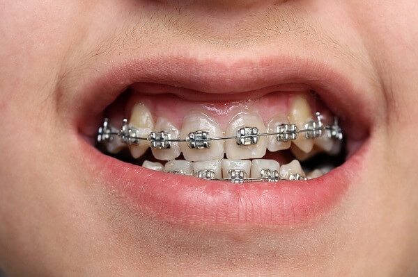niềng răng hô móm, niềng răng hô móm lệch lạc, niềng răng hô móm có đau không, quá trình niềng răng hô, quy trình niềng răng hô, 