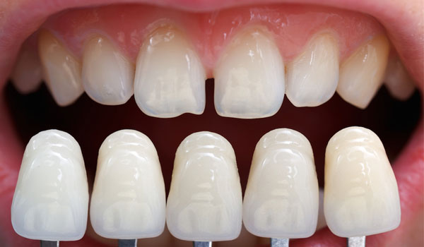 dán răng sứ, dán răng sứ giá, dán răng sứ thẩm mỹ, dán răng sứ được bao lâu, dán răng sứ có tốt không,dán răng sứ sử dụng được bao lâu, dán răng sứ có đau không, dán răng sứ bao nhiêu tiền, dán răng sứ có hại không,dán răng sứ có bền không, dán răng sứ giá bao nhiêu, dán răng sứ ở đâu tốt nhất, dán răng sứ loại nào tốt nhất, có nên dán răng sứ, dán răng sứ bao lâu, dán răng sứ mất bao lâu, độ bền của dán răng sứ