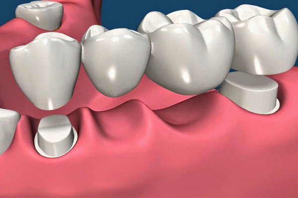 Cầu răng sứ giúp phục hình trong trường hợp răng bị mất