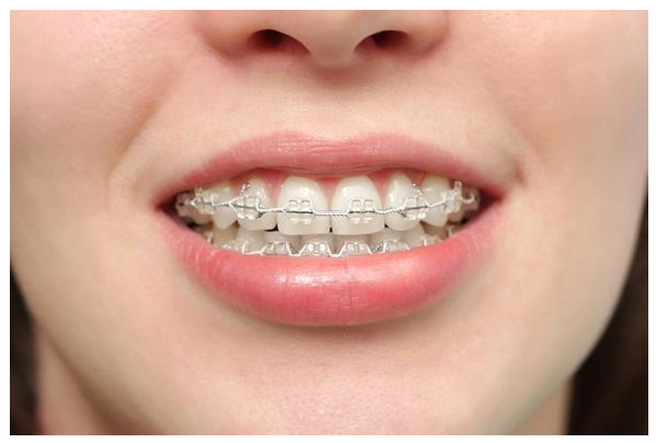 niềng răng nhổ răng số 4, răng số 4 là răng nào, nhổ răng số 4 có ảnh hưởng gì không, răng số 4 có mấy chân, nhổ răng số 4 có nguy hiểm không, nhổ răng số 4 hàm trên, niềng răng nhổ răng số 4 có nahr hưởng gì không,nhổ răng số 4 khi niềng răng, nhổ răng 4, rang so 4, nhổ răng số 4