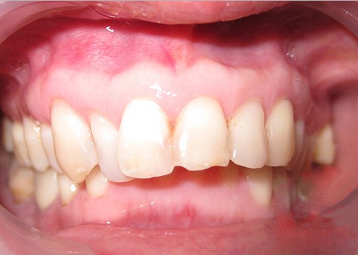 Có nên bọc răng sứ cho răng hô vẩu, có nên bọc răng sứ cho răng hô, bọc răng sứ cho răng hô vẩu, bọc răng sứ cho răng hô giá bao nhiêu, chi phí bọc răng sứ cho răng hô, răng hô có nên bọc sứ