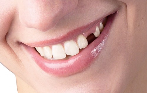 Niềng răng nhổ răng số 5 có nguy hiểm không?