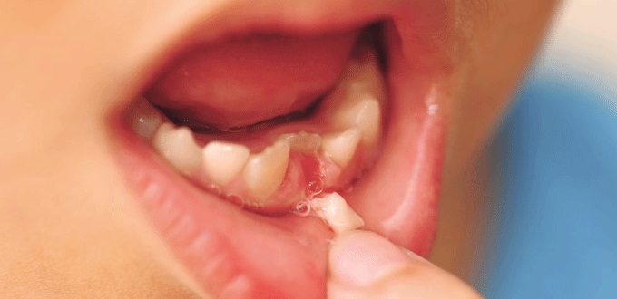 cách nhổ răng sữa cho bé,nhổ răng sữa,nhổ răng sữa cho bé,nhổ răng sữa chưa lung lay,cách nhổ răng sữa cho bé,nhổ răng sữa cho bé ở đâu,nhổ răng sữa còn chân,nhổ răng sữa bị sún,nhổ răng sữa cho trẻ,có nên nhổ răng sữa cho trẻ,nhổ răng sữa bị gãy chân,nhổ răng sữa bị sâu,giá nhổ răng sữa cho trẻ,nhổ răng sữa có mọc lại không
