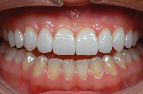 Chi phí bọc răng sứ cho răng sâu là bao nhiêu tiền, bọc răng sứ cho răng sâu giá bao nhiêu