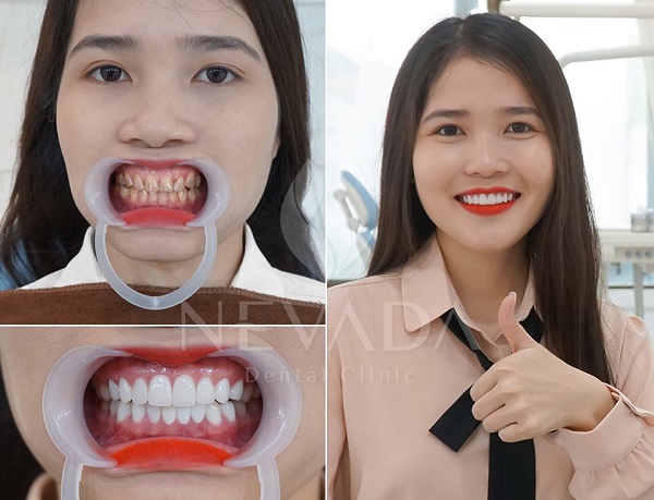 Chi phí bọc răng sứ cho răng sâu là bao nhiêu tiền, bọc răng sứ cho răng sâu giá bao nhiêu