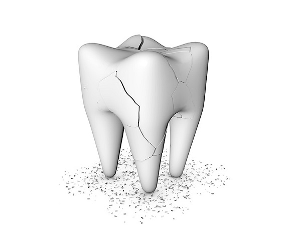 hiện tượng răng bị nứt nên làm gì,răng bị nứt,răng bị nứt có tự lành,răng bị nứt nhẹ,răng bị nứt vỡ,răng bị nứt nên làm gì,hiện tượng răng bị nứt,răng bị nứt đôi,tại sao răng bị nứt,răng bị nứt có sao không,răng bị nứt phải làm sao,răng bị nứt có trám được không,răng bị nứt chân,răng bị nứt có lành lại không