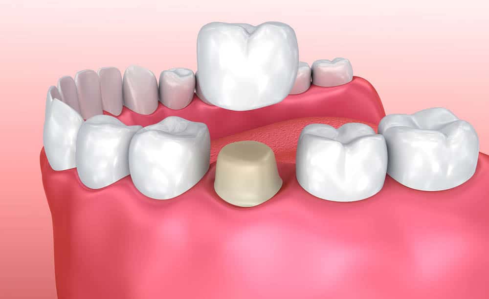 hiện tượng răng bị nứt nên làm gì,răng bị nứt,răng bị nứt có tự lành,răng bị nứt nhẹ,răng bị nứt vỡ,răng bị nứt nên làm gì,hiện tượng răng bị nứt,răng bị nứt đôi,tại sao răng bị nứt,răng bị nứt có sao không,răng bị nứt phải làm sao,răng bị nứt có trám được không,răng bị nứt chân,răng bị nứt có lành lại không