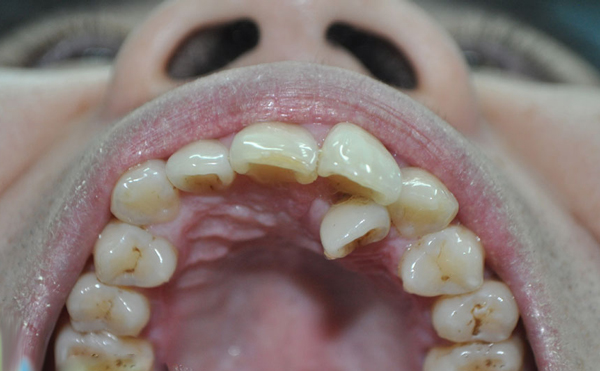 răng lòi xỉ,răng lòi xỉ có nhổ được không,hình răng lòi xỉ,hình ảnh răng lòi xỉ,răng lòi xỉ phải làm sao,răng lòi xỉ gây ảnh hưởng gì không,làm gì sau khi nhổ răng lòi xỉ,điều trị răng lòi xỉ,răng lòi xỉ có nguy hiểm không,nguyên nhân bị răng lòi xỉ,răng khểnh và răng lòi xỉ,răng lòi xỉ là gì,nhổ răng lòi xỉ,niềng răng lòi xỉ,bọc răng sứ cho răng lòi xỉ,răng bị lòi xỉ