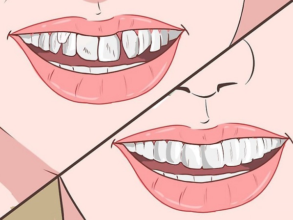 răng lòi xỉ,răng lòi xỉ có nhổ được không,hình răng lòi xỉ,hình ảnh răng lòi xỉ,răng lòi xỉ phải làm sao,răng lòi xỉ gây ảnh hưởng gì không,làm gì sau khi nhổ răng lòi xỉ,điều trị răng lòi xỉ,răng lòi xỉ có nguy hiểm không,nguyên nhân bị răng lòi xỉ,răng khểnh và răng lòi xỉ,răng lòi xỉ là gì,nhổ răng lòi xỉ,niềng răng lòi xỉ,bọc răng sứ cho răng lòi xỉ,răng bị lòi xỉ