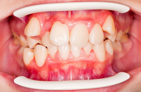 răng mọc lộn xộn phải làm sao,răng mọc lộn xộn,răng mọc lộn xộn phải làm sao,nguyên nhân răng mọc lộn xộn,răng mọc lộn xộn bọc sứ được không,răng mọc lộn xộn là gì,quy trình bọc sứ răng mọc lộn xộn,bọc sứ răng mọc lộn xộn giá bao nhiêu,chi phí bọc sứ răng mọc lộn xộn,răng hàm dưới mọc lộn xộn
