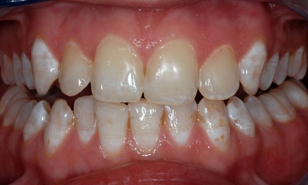 Bọc răng sứ HI-Zirconia cho răng bị nhiễm kháng sinh