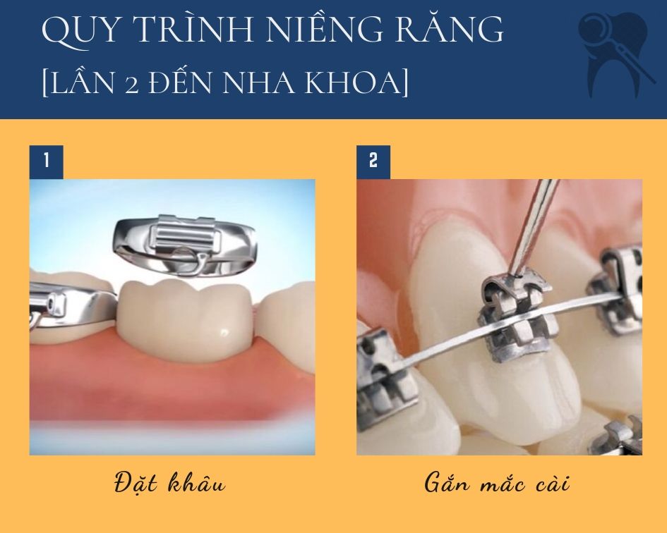 quy trình niềng răng mắc cài kim loại, quy trình, niềng răng mắc cài, kim loại, 