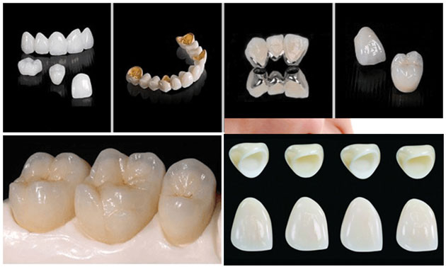bọc răng sứ chữa hô, bọc răng sứ trị hô, bọc răng sứ cho hàm hô, chữa răng hô bằng cách bọc răng sứ