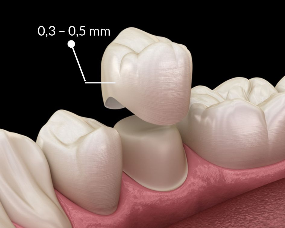 bọc răng sứ cho răng cửa bị mẻ, bọc răng sứ cho răng bị mẻ, bọc răng sứ 2 răng cửa bị mẻ, bọc sứ răng cửa bị mẻ, phục hồi răng mẻ, Răng cửa bị mẻ phải làm sao