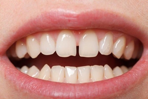 xem bói răng, xem bói răng thưa, xem bói răng cửa, xem bói răng cửa thưa, xem bói răng khểnh, xem bói răng hô, xem bói răng ngắn, xem bói hàm răng, xem bói về răng, xem bói qua răng