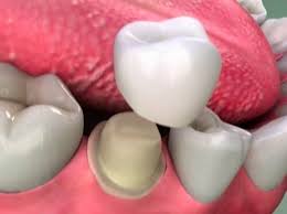 tháo răng sứ làm lại có đau không, làm lại răng sứ có đau không, bọc lại răng sứ có đau không