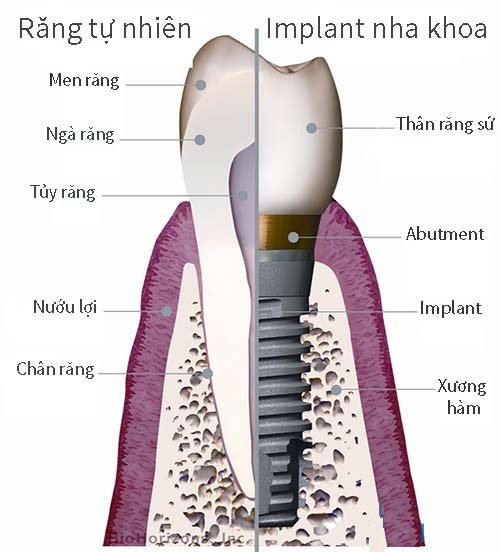 cấy ghép implant mất thời gian bao lâu, lợi ích của cấy ghép implant, cấy ghép răng, quy trình làm răng implant