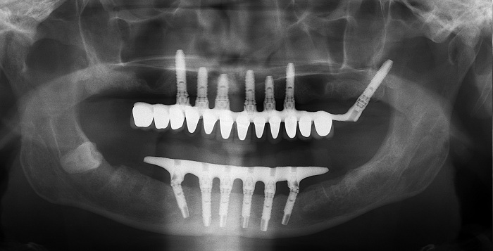 cấy răng implant, cấy răng implant toàn hàm, trồng hàm implant nguyên hàm