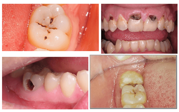 nhổ răng không đau, cách nhổ răng không đau, nhổ răng an toàn, mẹo nhổ răng không đau, phương pháp nhổ răng không đau, nhổ răng đau không, cách nhổ răng, trước khi nhổ răng nên làm gì, nhổ răng, nhổ răng an toàn, nhổ răng an toàn hà nội, cách nhổ răng an toàn, quy trình nhổ răng, địa chỉ nhổ răng uy tín tại hà nội, địa chỉ nhổ răng uy tín, địa chỉ nhổ răng uy tín ở hà nội, công nghệ nhổ răng không đau, nho rang khong dau, cách bẻ răng không đau, cách nhổ răng sâu không đau
