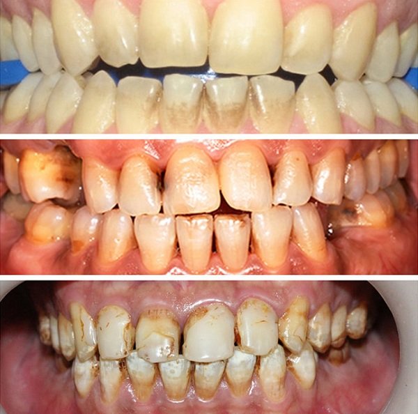 quy trình bọc răng sứ, quy trình bọc răng sứ thẩm mỹ, quá trình bọc răng sứ mất bao lâu , quy trình bọc răng sứ thẩm mỹ có đau không