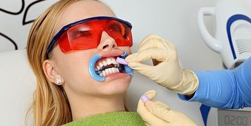 Quy trình tẩy trắng răng tại nha khoa
