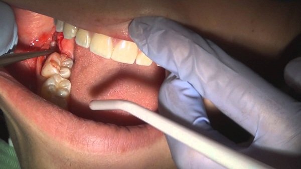 lớp màng trắng sau khi nhổ răng, màng trắng sau khi nhổ răng, vết nhổ răng khôn có màu trắng, màng trắng sau nhổ răng, vết nhổ răng có màng trắng, màng trắng sau khi nhổ răng khôn, xuất hiện màng trắng sau khi nhổ răng, màng trắng sau nhổ răng là gì