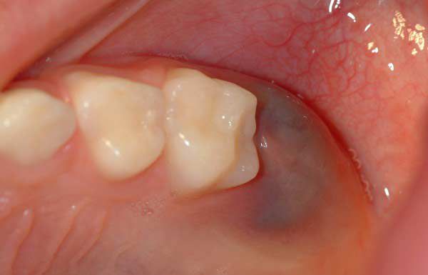 sưng nướu răng hàm trên, sưng lợi hàm trên, sưng lợi răng hàm trên, sưng nướu hàm trên, đau lợi hàm trên, viêm lợi hàm trên, sưng nướu răng trong cùng hàm trên, viêm nướu răng hàm trên, sưng lợi trong cùng hàm trên, sưng lợi răng hàm, bị sưng nướu răng trong cùng hàm trên, bị sưng lợi hàm trên, sưng chân răng hàm trên, đau nướu hàm trên