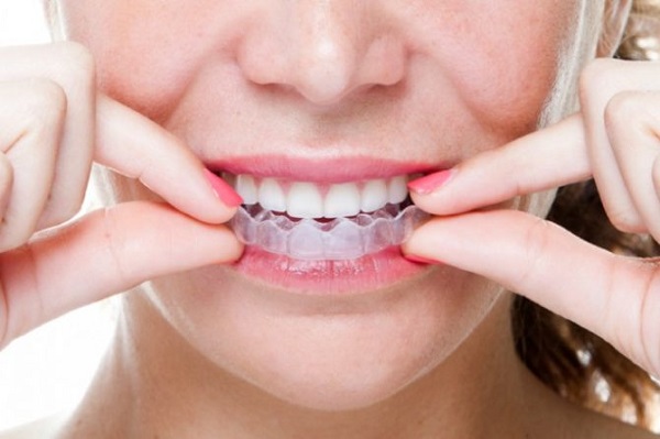 niềng răng silicon, niềng răng silicon cho người lớn, miếng niềng răng silicon, miếng niềng răng silicon cho người lớn có hiệu quả không
