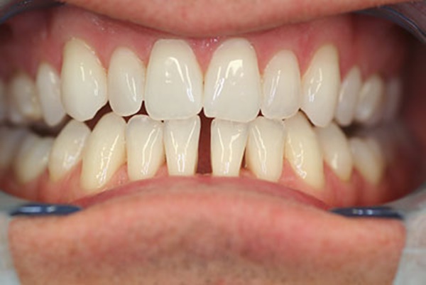 răng thưa bọc sứ duy trì được bao lâu, răng thưa bọc sứ sử dụng được bao lâu