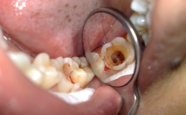 viêm tủy răng, viêm tuỷ răng phải làm sao, cách chữa viêm tủy răng tại nhà, thuốc kháng sinh điều trị viêm tủy răng, trị viêm tủy răng tại nhà, viêm tủy răng có mủ, chữa viêm tủy răng xong vẫn đau nhức, bị viêm tủy răng uống thuốc gì, viêm tủy răng mãn tính, viêm tủy răng là gì, bệnh viêm tủy răng, triệu chứng viêm tủy răng, viêm tủy răng có nguy hiểm không, cách chữa tủy răng tại nhà, cách trị viêm tủy răng tại nhà, đơn thuốc viêm tủy răng, thuốc trị viêm tủy răng, thuốc trị viêm tủy răng, cách làm chết tủy răng tại nhà, cách chữa viêm tủy răng