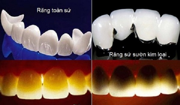 ưu nhược điểm của các loại răng sứ, ưu và nhược điểm của các loại răng sứ, ưu nhược điểm của bọc răng sứ, ưu nhược điểm của răng sứ